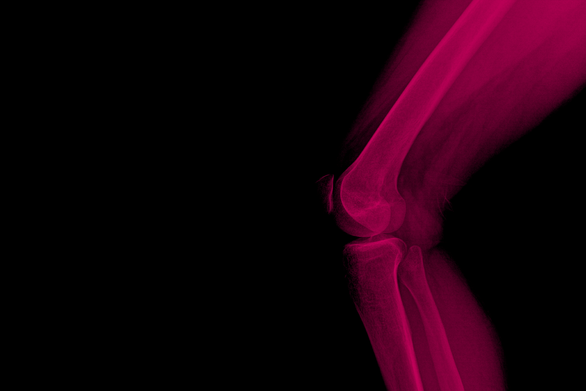 Gonarthrose en milieu thermal : quels avantages ?
