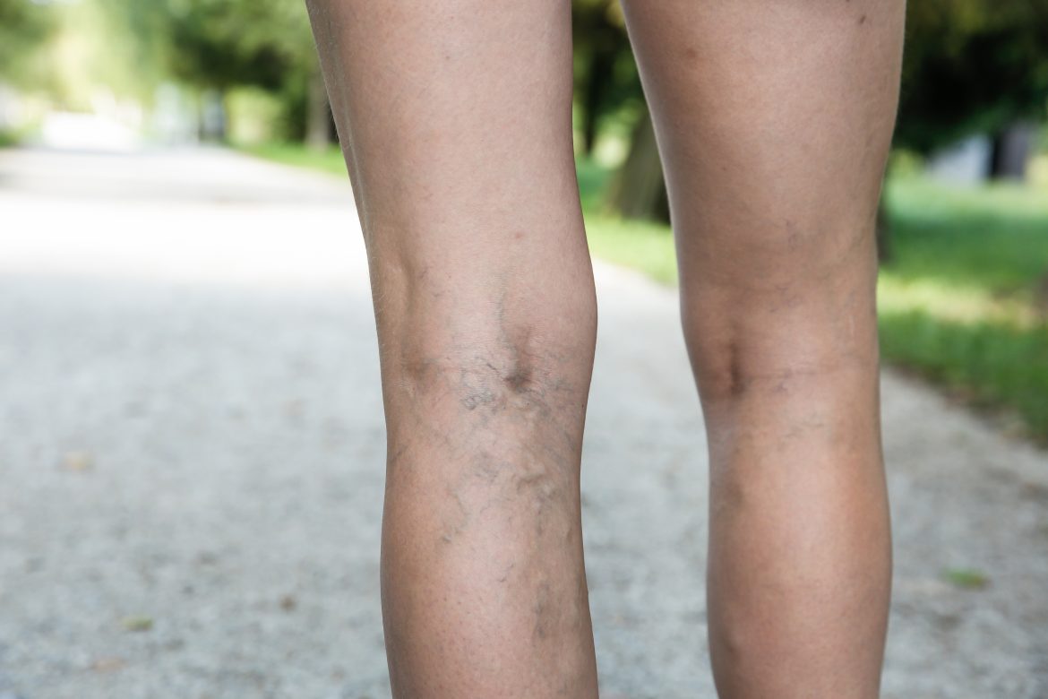 Soulager la phlébologie chez soi avec des exercices simples